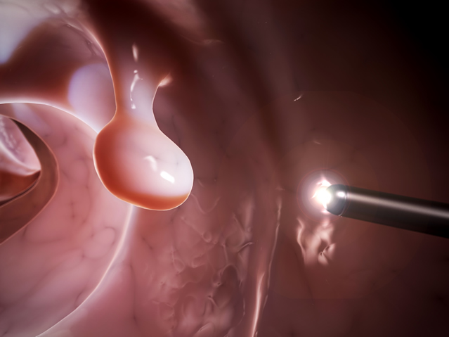 colonoscopy